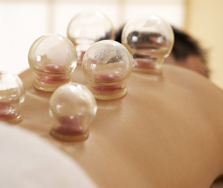 Cupping therapy session in Ghatkopar for pain relief