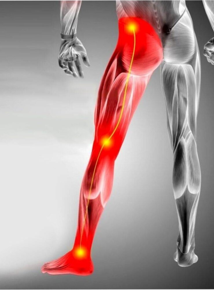 Physiotherapy session for lower back and leg pain at PhysioRelieve