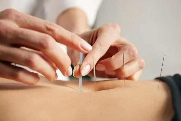 acupuncture-treatment